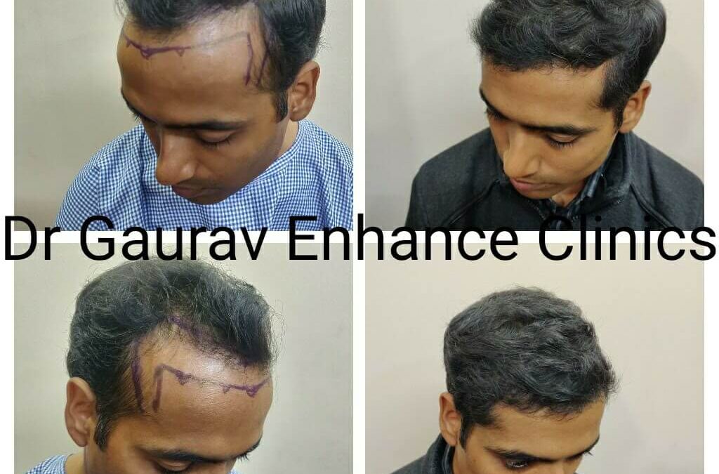 Hair Transplant Results At Cult Aesthetics 6