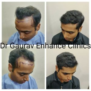 Hair Transplant Results At Cult Aesthetics 6 - Cult Aesthetics Gurgaon