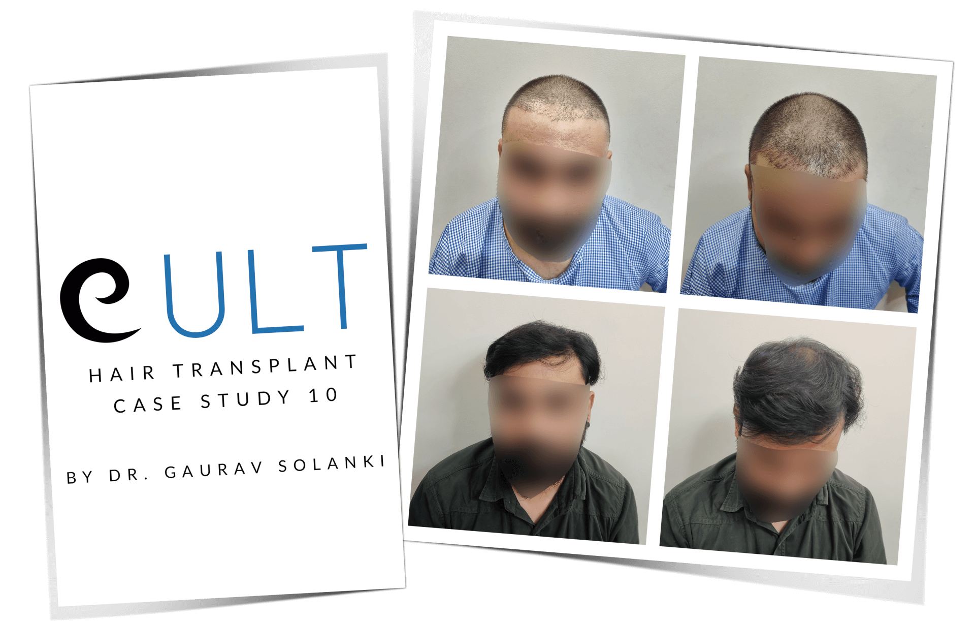 Hair Transplant Results Case Study 10