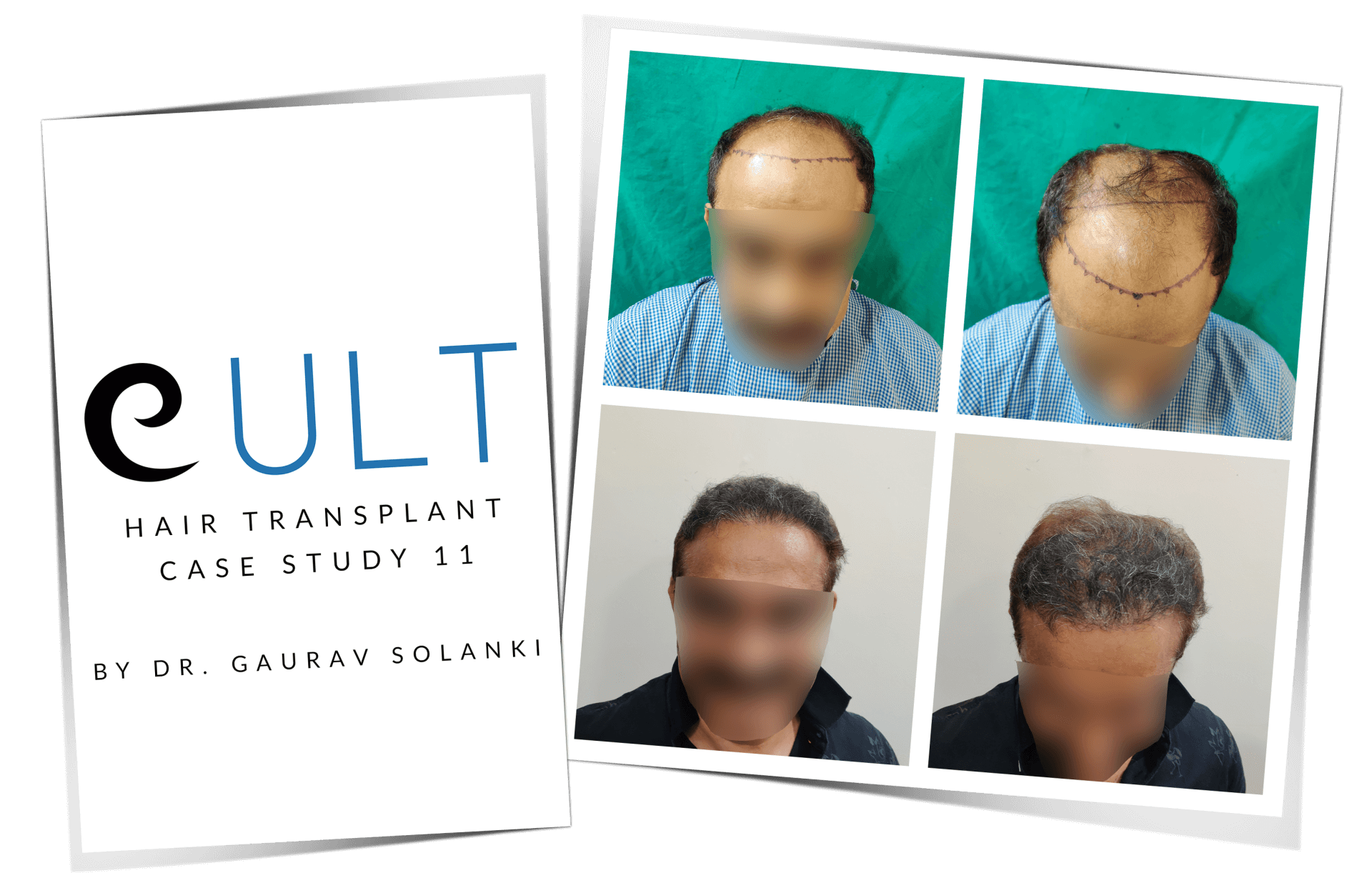 Hair Transplant Results Case Study 11