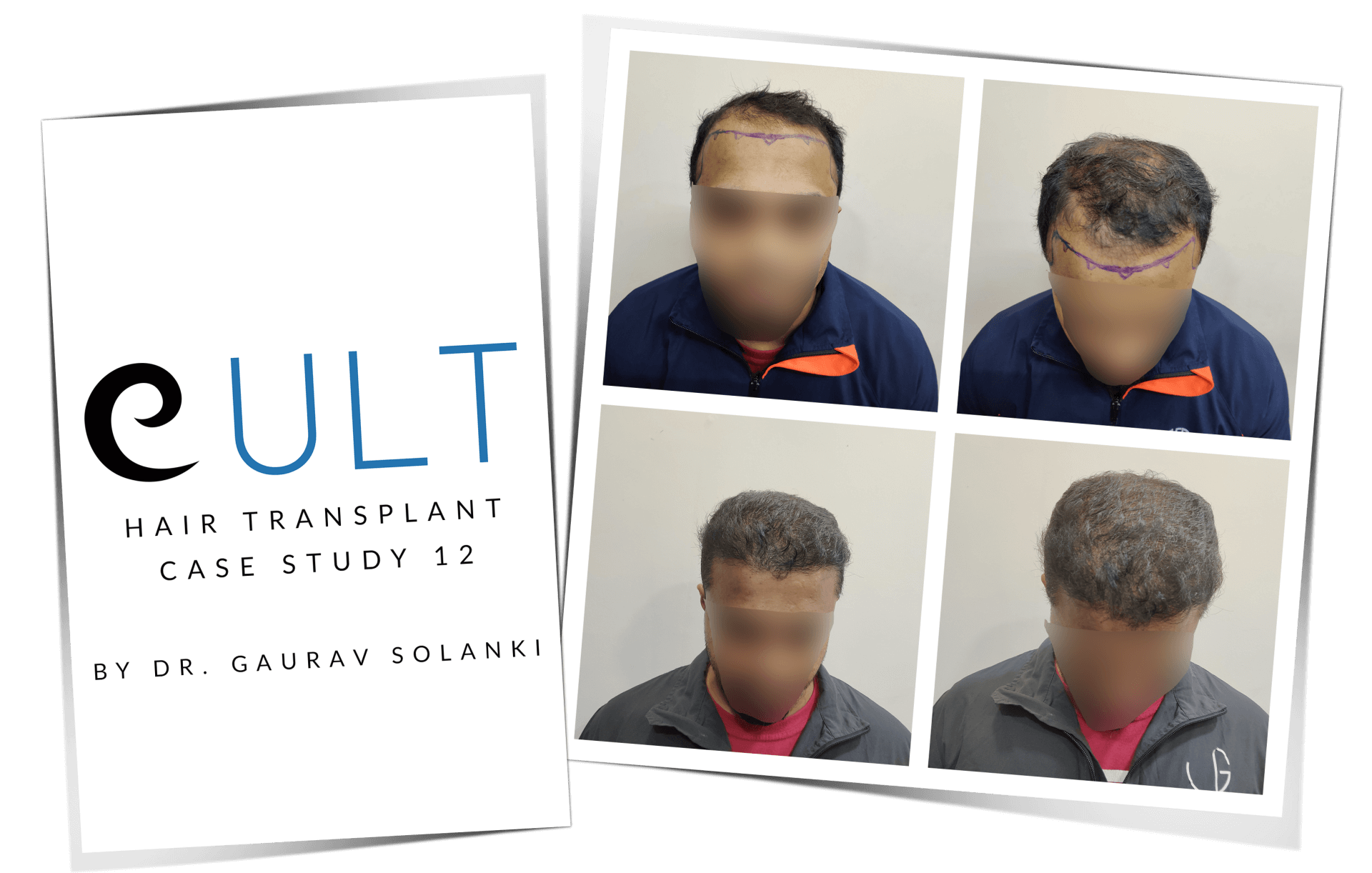 Hair Transplant Results Case Study 12
