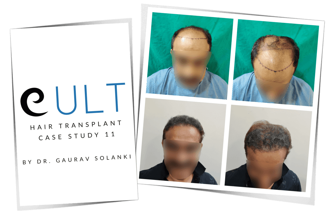Hair Transplant Case Study 11