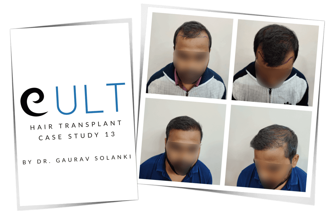 Hair Transplant Case Study 13