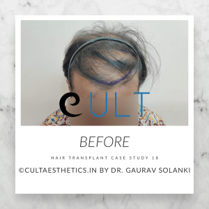Cult 18 HT Before Final 2 - Hair Transplant Clinic in Gurgaon
