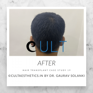 Cult Aesthetics - Hair Transplant Clinic Gurgaon