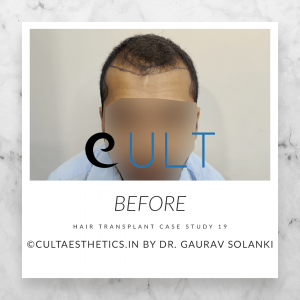 Cult Aesthetics - Hair Transplant Clinic Gurgaon