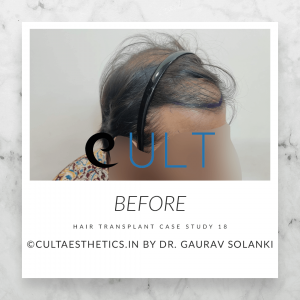 Cult Aesthetics - Hair Transplant Clinic Gurgaon