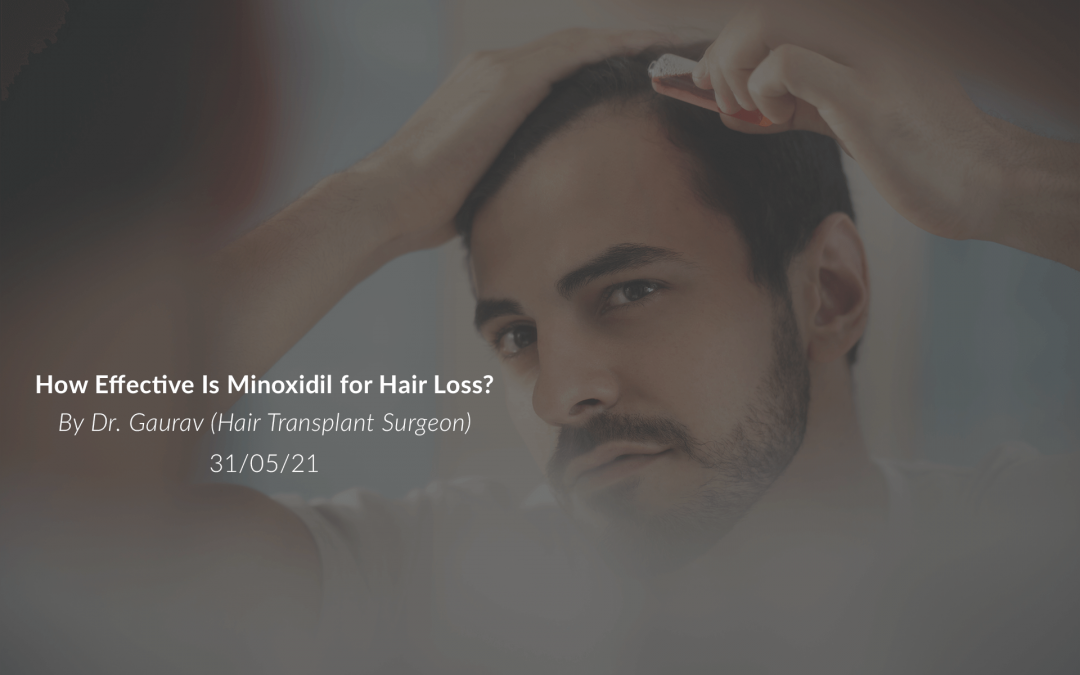 How Effective Is Minoxidil for Hair Loss?