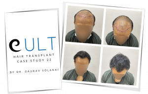 Caset Study 22 Cover - Hair Transplant Clinic in Gurgaon