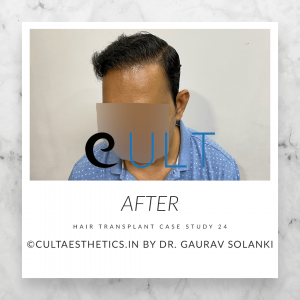 Hair Transplant Case 24 - After Results at Cult Aesthetics Gurgaon