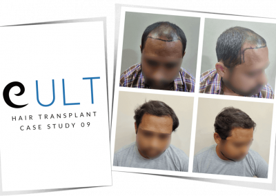 Hair Transplant Results at Cult Aesthetics 09