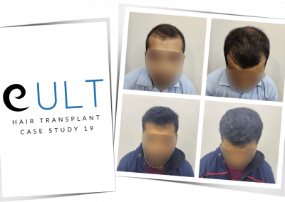 Hair Transplant Results at Cult Aesthetics 19