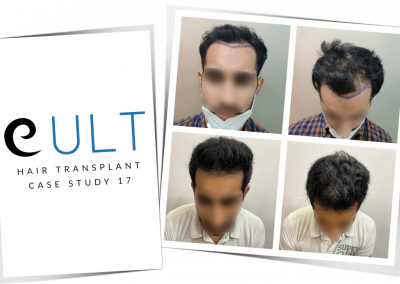 Hair Transplant Results at Cult Aesthetics 17