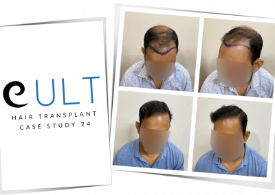 Hair Transplant Results at Cult Aesthetics 24