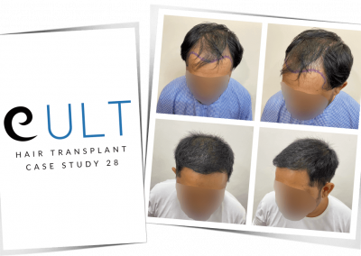 Hair Transplant Results at Cult Aesthetics 28