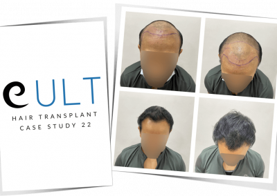 Hair Transplant Results at Cult Aesthetics 22