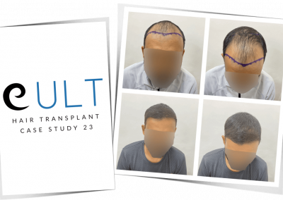 Hair Transplant Results at Cult Aesthetics 23