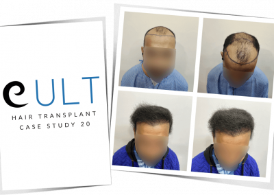 Hair Transplant Results at Cult Aesthetics 20