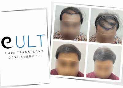 Hair Transplant Results at Cult Aesthetics 18