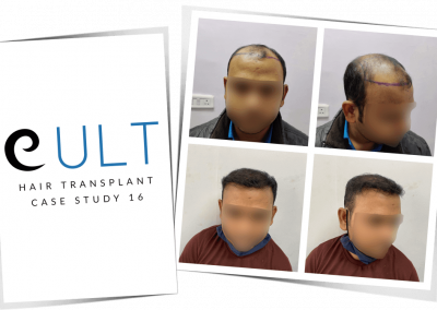 Hair Transplant Results at Cult Aesthetics 16