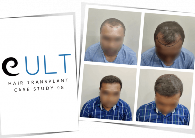 Hair Transplant Results at Cult Aesthetics 08
