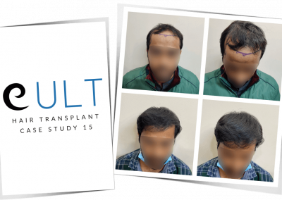 Hair Transplant Results at Cult Aesthetics 15