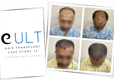 Hair Transplant Results at Cult Aesthetics 14