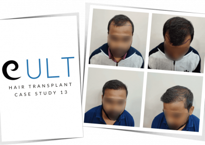 Hair Transplant Results at Cult Aesthetics 13
