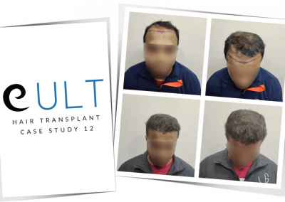 Hair Transplant Results at Cult Aesthetics 12