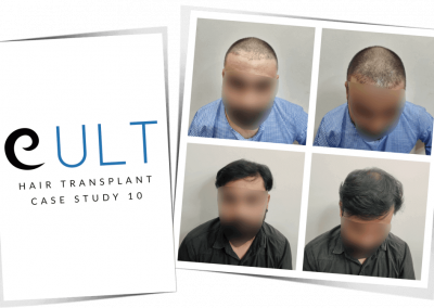 Hair Transplant Results at Cult Aesthetics 10
