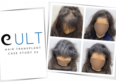 Hair Transplant Results at Cult Aesthetics 26