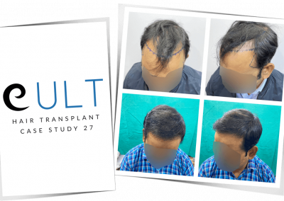 Hair Transplant Results at Cult Aesthetics 27