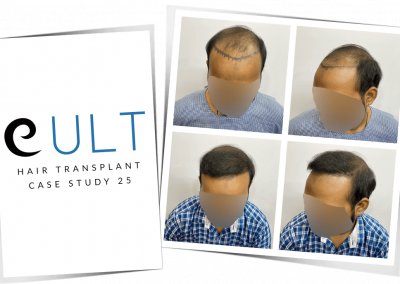 Hair Transplant Results at Cult Aesthetics 25