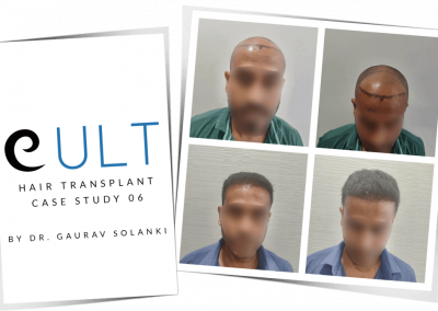 Hair Transplant Results at Cult Aesthetics 06
