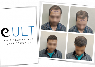 Hair Transplant Results at Cult Aesthetics 05