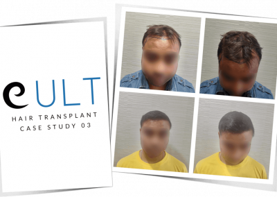Hair Transplant Results at Cult Aesthetics 03