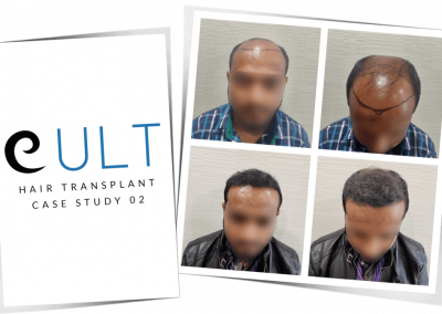 Hair Transplant Results at Cult Aesthetics 02