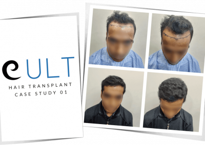 Hair Transplant Results at Cult Aesthetics 01