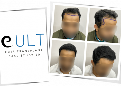 Hair Transplant Results at Cult Aesthetics 30