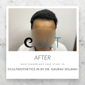 Hair transplant case study 30 before and after results by Dr Gaurav Solanki
