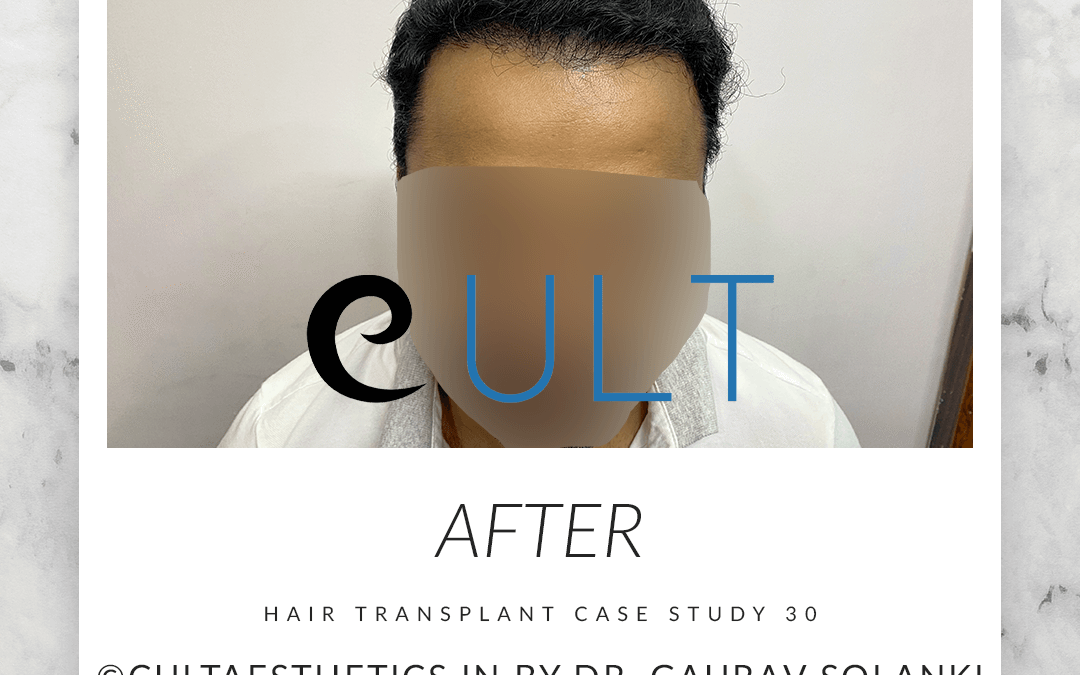 Case Study 30 After 1