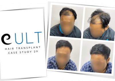 Hair Transplant Results at Cult Aesthetics 29