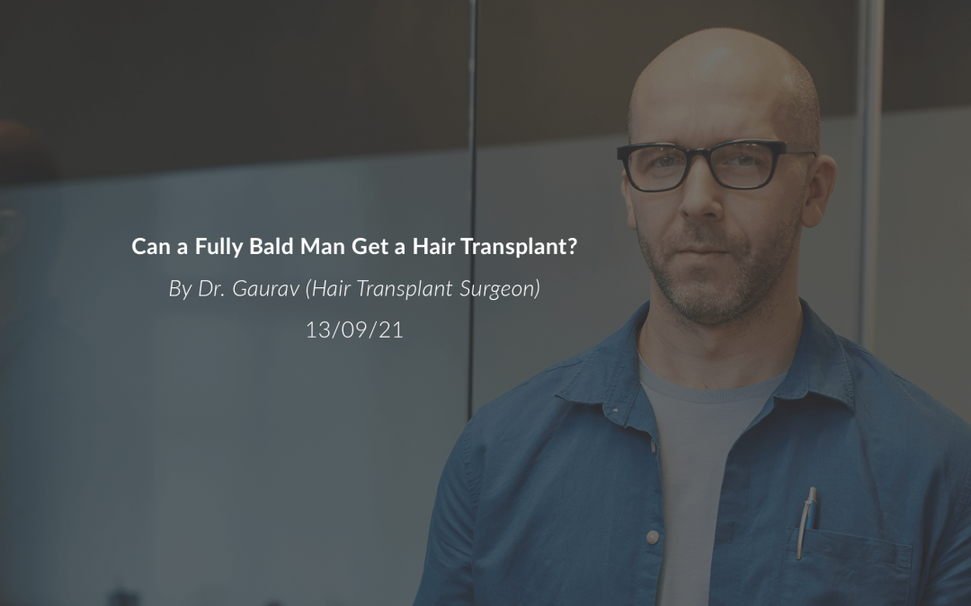 Can a Fully Bald Man Get a Hair Transplant?