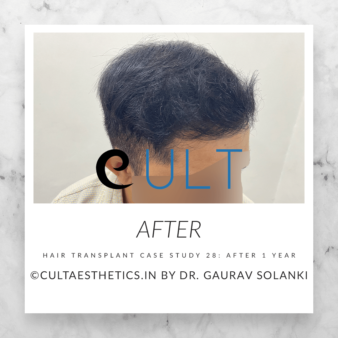 Hair Transplant Results at Cult Aesthetics 18- After 1yr