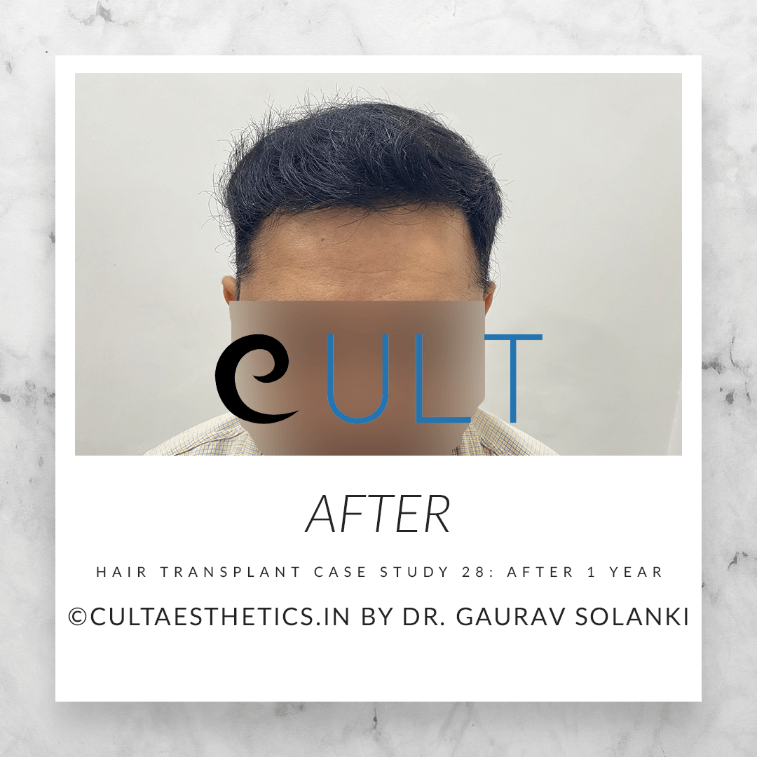 Hair Transplant Results at Cult Aesthetics 18- After 1yr