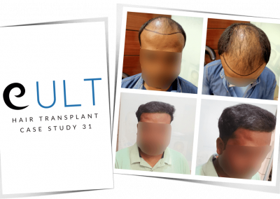 Hair Transplant Results at Cult Aesthetics 31
