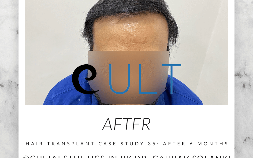 Case 35 After 6 Months 6