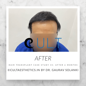 Hair Transplant Case 35 - After Results at Cult Aesthetics Gurgaon