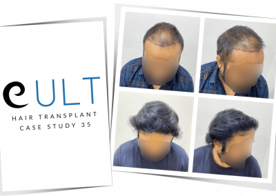 Hair Transplant Results at Cult Aesthetics 35