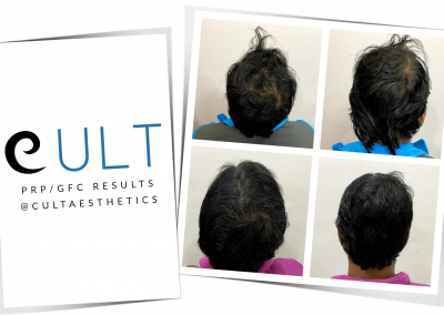GFC Treatment Results at Cult Aesthetics